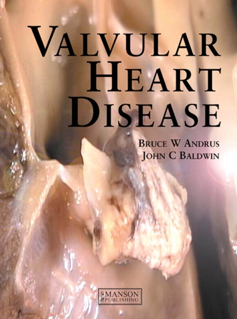 Valvular Heart Disease, PDF eBook