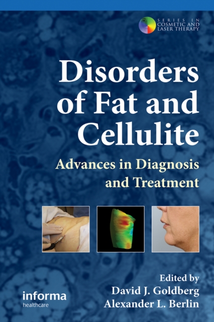 Disorders of Fat and Cellulite : Advances in Diagnosis and Treatment, PDF eBook