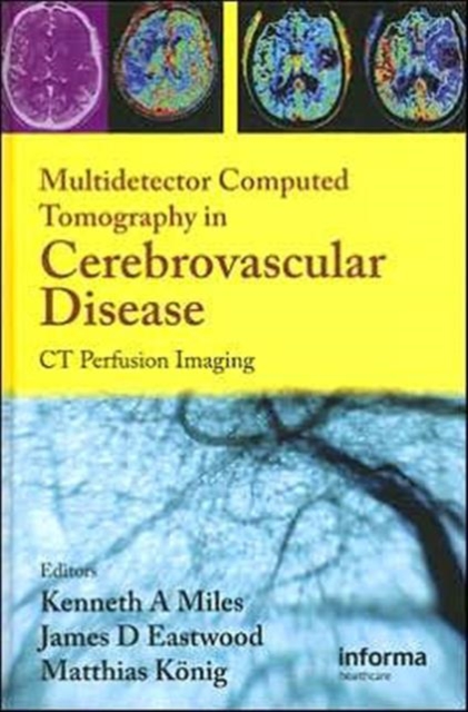 Multidetector Computed Tomography in Cerebrovascular Disease : CT Perfusion Imaging, Hardback Book
