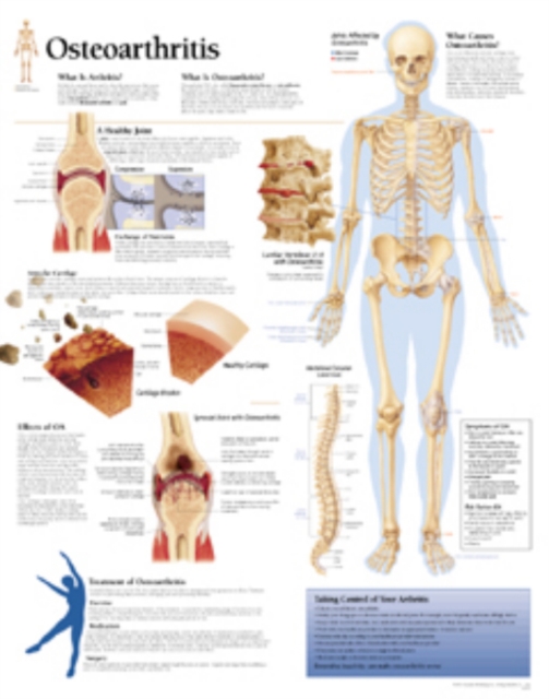 Osteoarthritis Laminated Poster, Poster Book