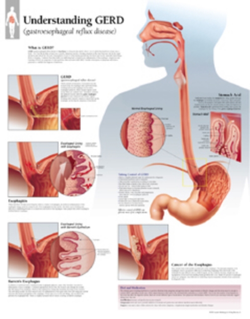Understanding GERD (Gastroesophageal Reflux Disease) Laminated Poster, Poster Book
