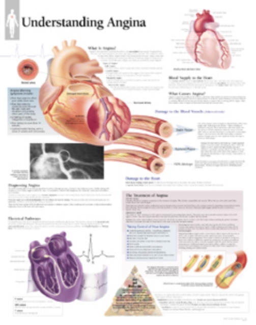 Understanding Angina Laminated Poster, Poster Book
