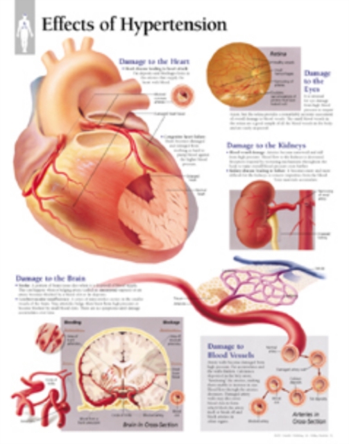 Effects of Hypertension Laminated Poster, Poster Book