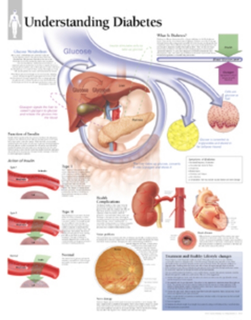 Understanding Diabetes Laminated Poster, Poster Book