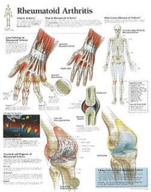 Rheumatoid Arthritis Laminated Poster, Poster Book