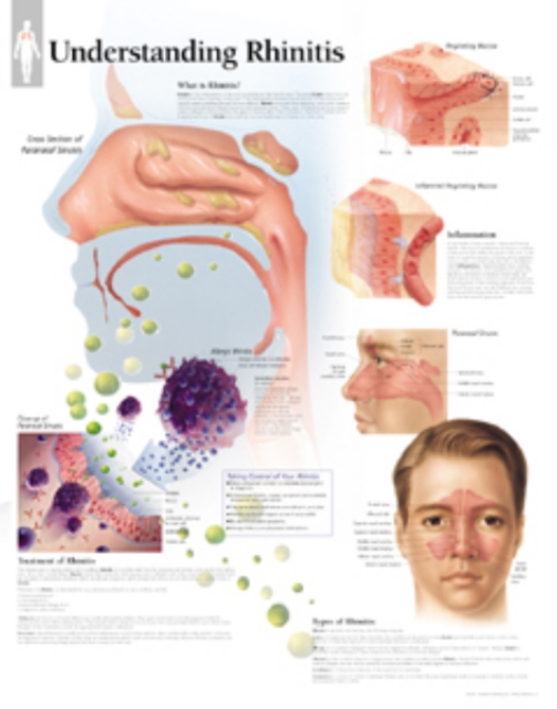Understanding Rhinitis Laminated Poster, Poster Book