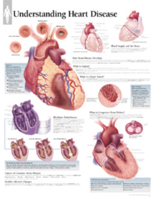 Understanding Heart Disease Laminated Poster, Poster Book