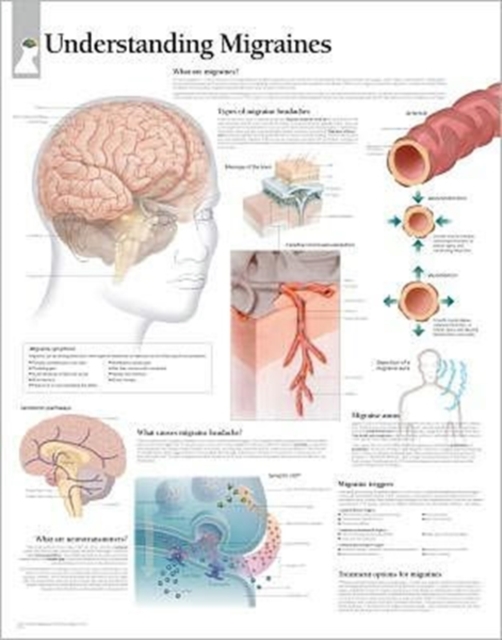 Understanding Migraines Laminated Poster, Poster Book