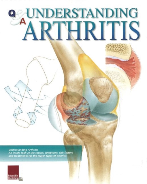 Understanding Arthritis Flip Chart, Spiral bound Book