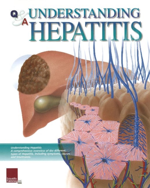 Understanding Hepatitis Flip Chart, Spiral bound Book