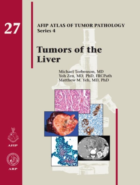 Tumors of the Liver, Hardback Book