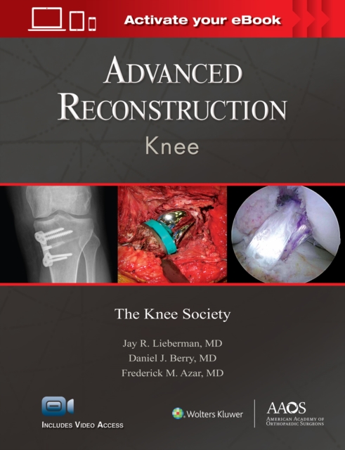 Advanced Reconstruction: Knee: Print + Ebook with Multimedia, Hardback Book