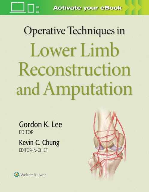 Operative Techniques in Lower Limb  Reconstruction and Amputation, Hardback Book