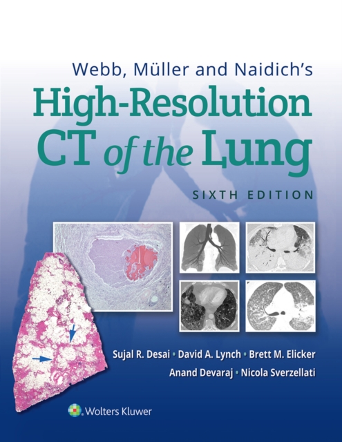 Webb, Muller and Naidich's High-Resolution CT of the Lung, EPUB eBook