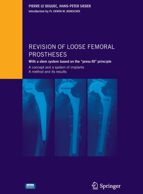 Revision of loose femoral prostheses with a stem system based on the "press-fit" principle : A concept and its system of implants, a method and its results, Multiple-component retail product Book