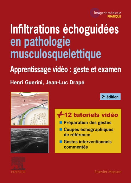 Infiltrations echoguidees en pathologie musculosquelettique : Apprentissage video : geste et examen, EPUB eBook