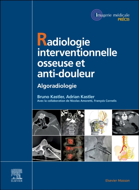 Radiologie Interventionnelle osseuse et anti-douleur : Algoradiologie, EPUB eBook