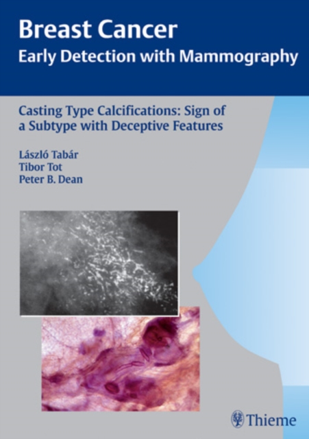Casting-Type Calcifications: Sign of a Subtype with Deceptive Features, Hardback Book
