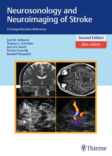 Neurosonology and Neuroimaging of Stroke : A Comprehensive Reference, Hardback Book