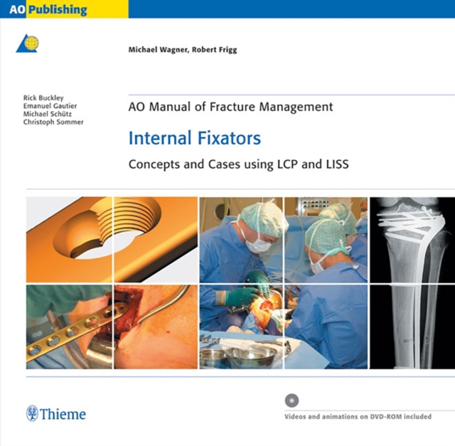 AO Manual of Fracture Management: Internal Fixators : Concepts and Cases using LCP/LISS, Hardback Book