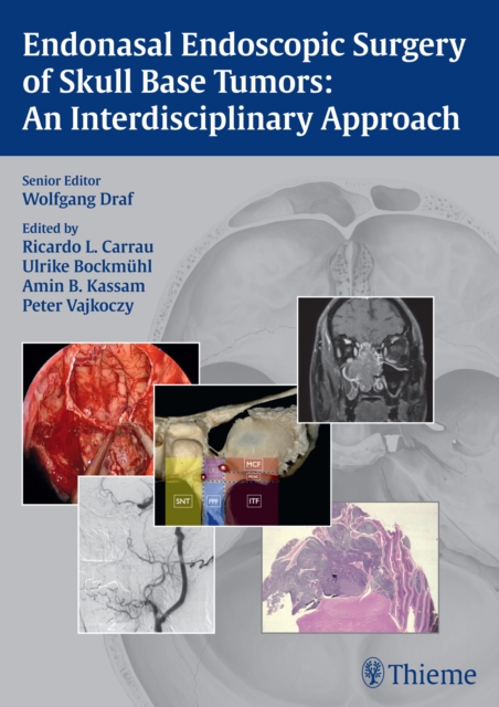 Endonasal Endoscopic Surgery of Skull Base Tumors: An Interdisciplinary Approach, Hardback Book