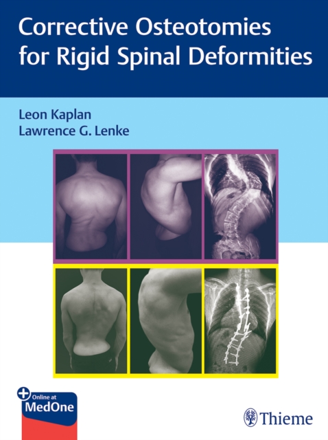 Corrective Osteotomies for Rigid Spinal Deformities, Multiple-component retail product, part(s) enclose Book