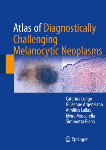 Atlas of Diagnostically Challenging Melanocytic Neoplasms, Hardback Book
