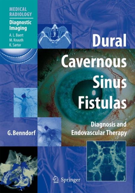 Dural Cavernous Sinus Fistulas : Diagnosis and Endovascular Therapy, Hardback Book