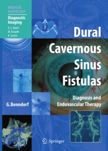 Dural Cavernous Sinus Fistulas : Diagnosis and Endovascular Therapy, PDF eBook