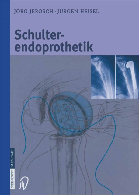 Schulterendoprothetik : Indikation, Implantate, OP-Technik, Nachbehandlung, Begutachtung, PDF eBook