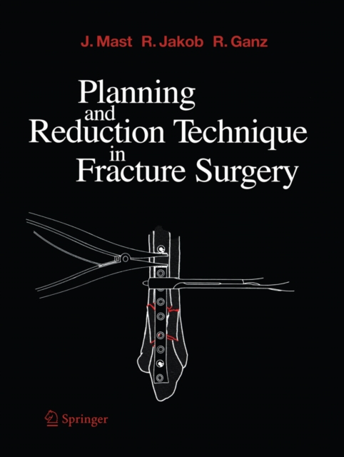 Planning and Reduction Technique in Fracture Surgery, PDF eBook