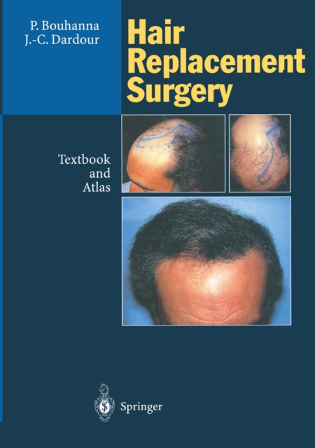 Hair Replacement Surgery : Textbook and Atlas, PDF eBook