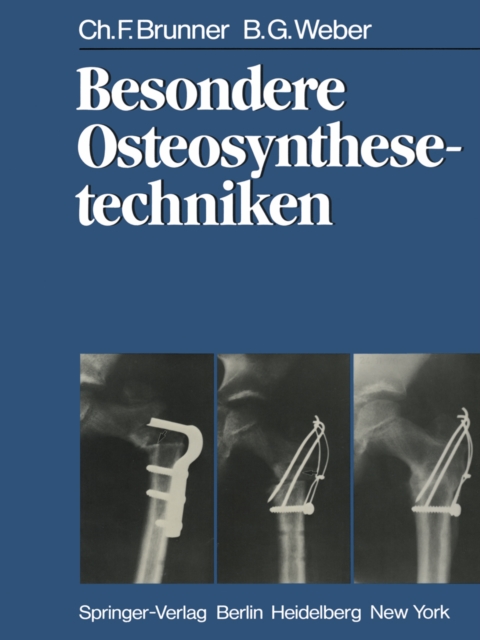 Besondere Osteosynthesetechniken, PDF eBook