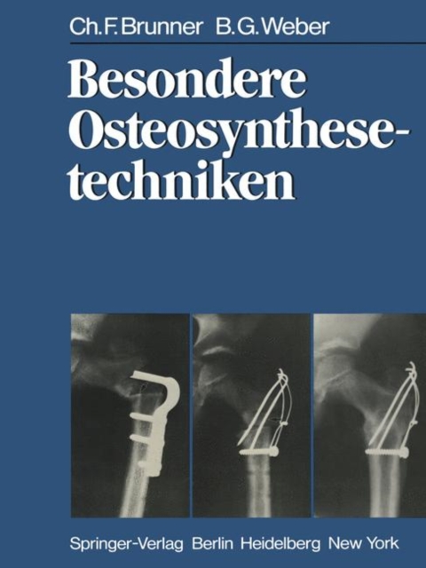 Besondere Osteosynthesetechniken, Paperback Book