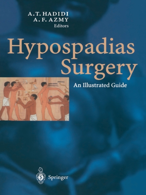 Hypospadias Surgery : An Illustrated Guide, Paperback / softback Book