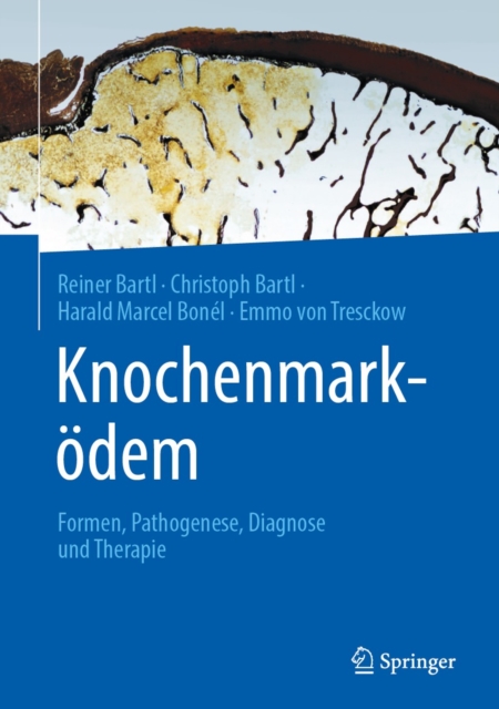 Knochenmarkodem : Formen, Pathogenese, Diagnose und Therapie, EPUB eBook
