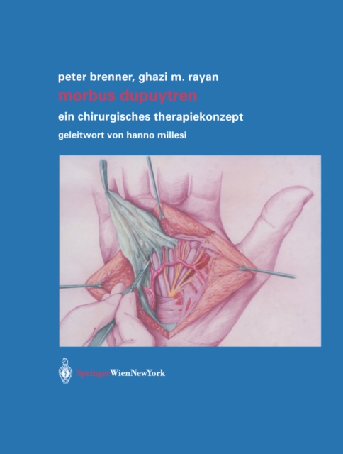 Morbus Dupuytren : Ein chirurgisches Therapiekonzept, PDF eBook
