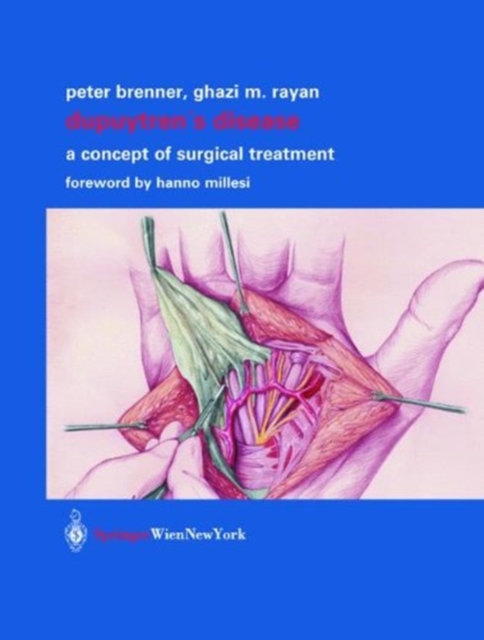 Dupuytren's Disease : A Concept of Surgical Treatment, Paperback / softback Book