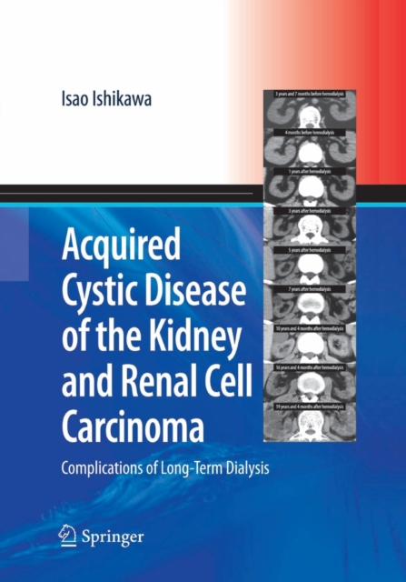 Acquired Cystic Disease of the Kidney and Renal Cell Carcinoma : Complication of Long-Term Dialysis, Paperback / softback Book