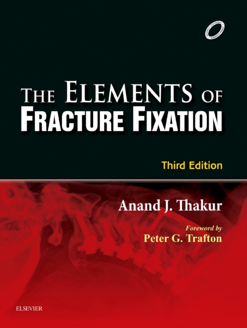 Elements of Fracture Fixation - E-book, EPUB eBook