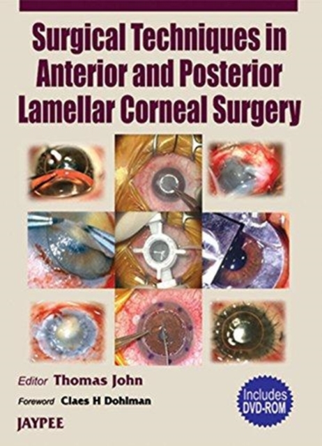 Surgical Techniques in Anterior and Posterior Lamellar Corneal Surgery, Multiple-component retail product Book