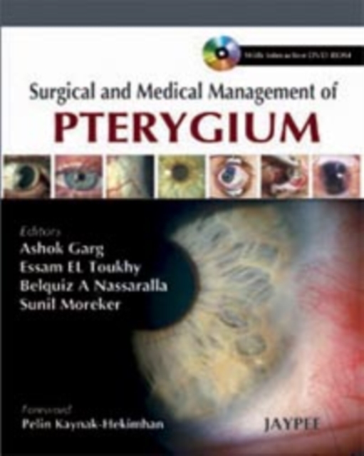 Surgical and Medical Management of Pterygium, Hardback Book
