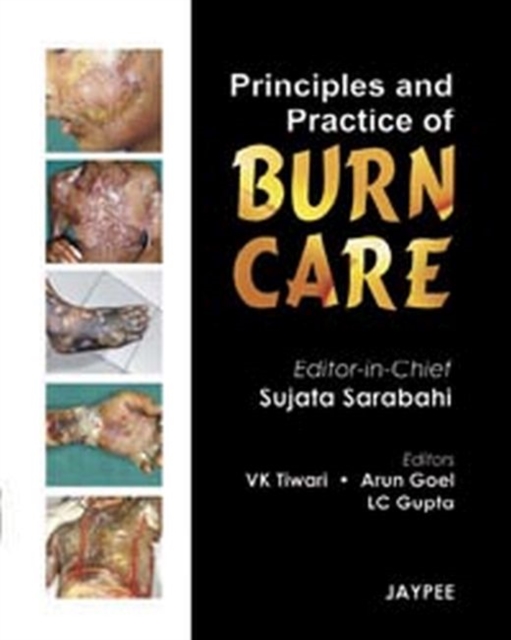 Principles and Practice of Burn Care, Hardback Book