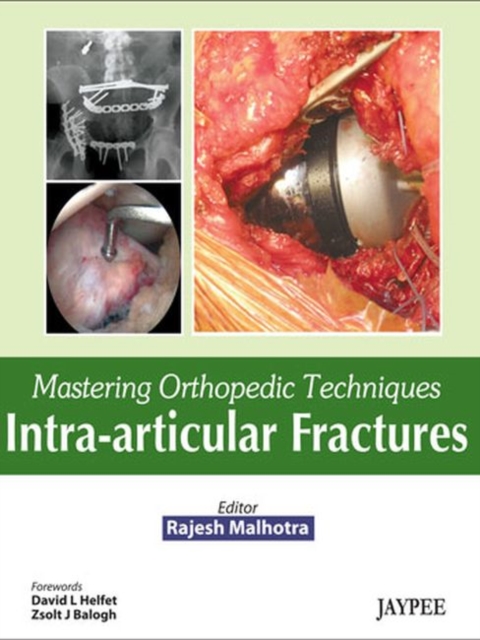 Mastering Orthopedic Techniques: Intra-Articular Fractures, Hardback Book