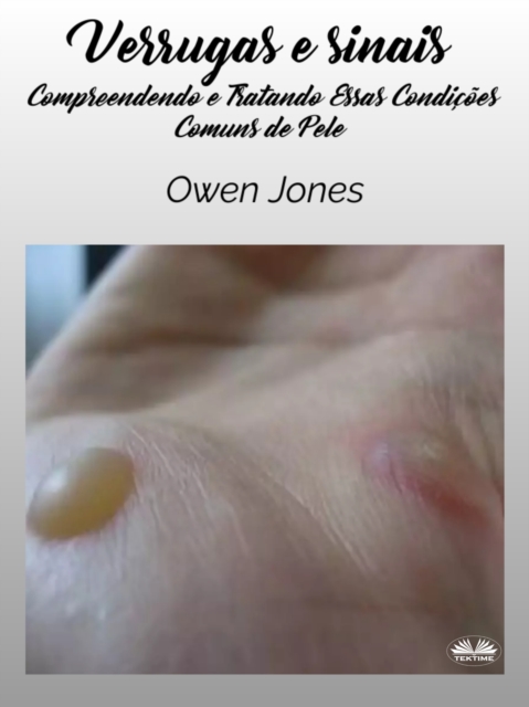 Verrugas E Sinais : Entendendo E Tratando Essas Doencas De Pele Comuns, EPUB eBook