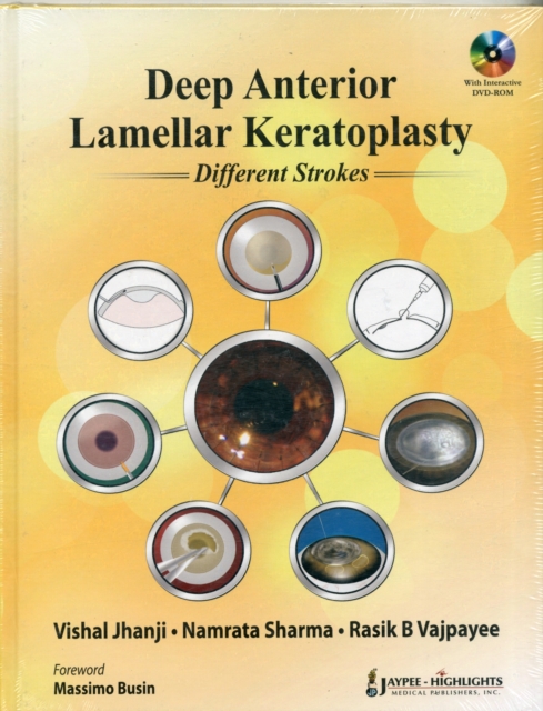 Deep Anterior Lamellar Keratoplasty Different Strokes, Mixed media product Book