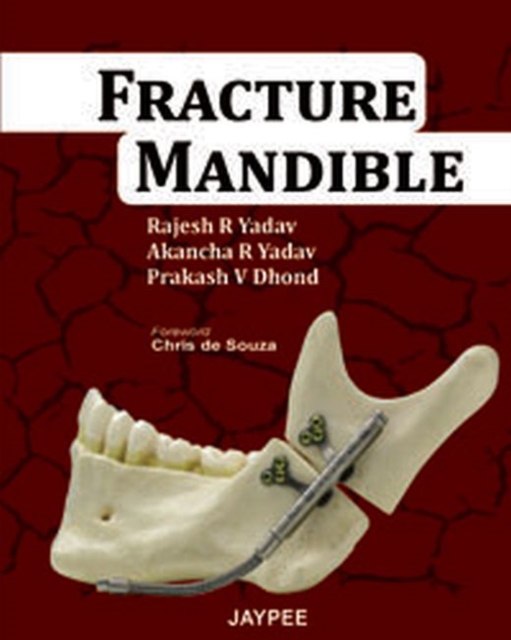 Fracture Mandible, Paperback / softback Book