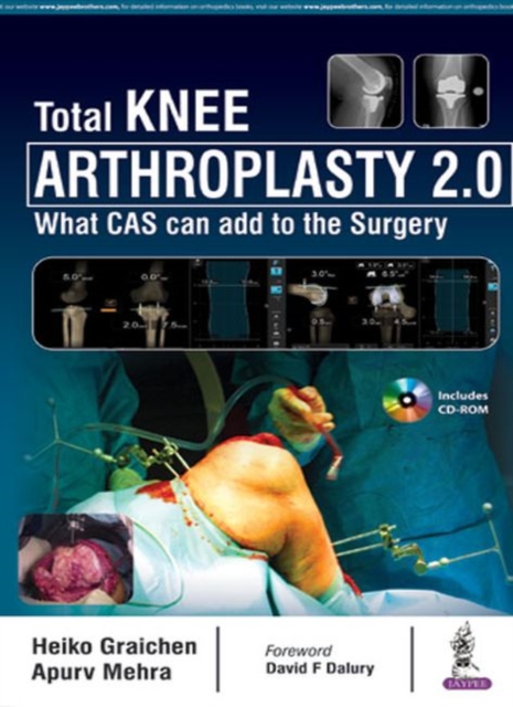 Total Knee Arthroplasty 2.0 : What CAS can add to the Surgery, Hardback Book