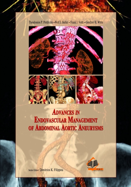 Advances in Endovascular Management of Abdominal Aortic Aneurysms, Hardback Book